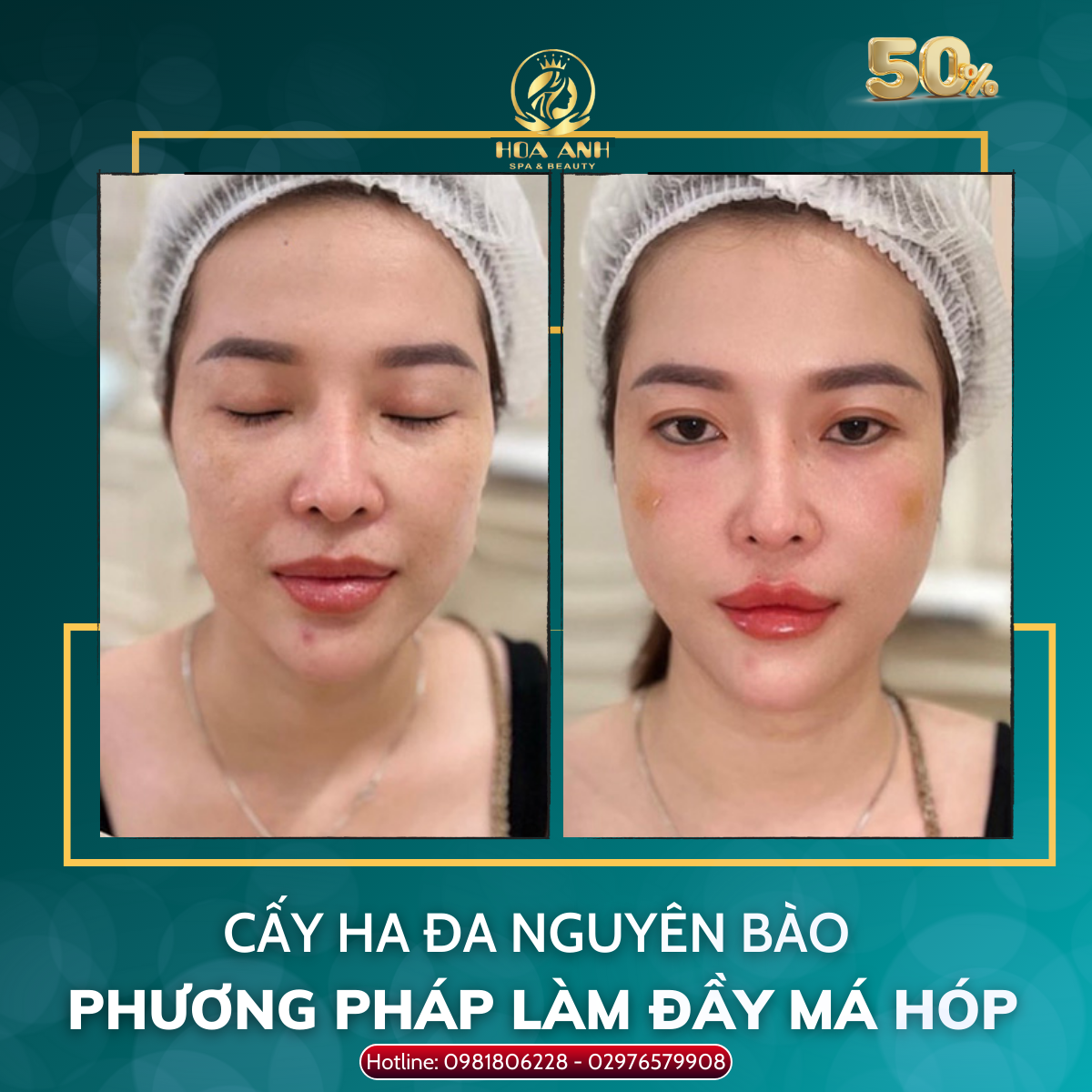 Tiêm filler bị nổi mụn có nguy hiểm không?